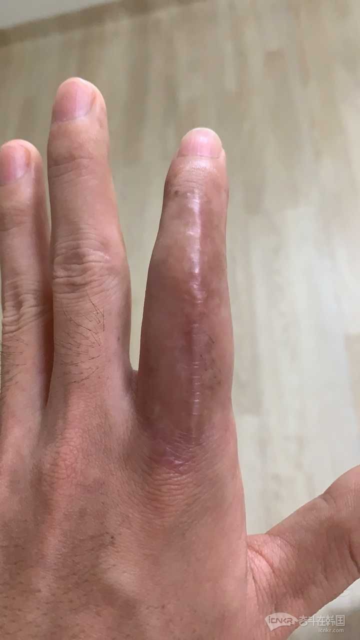 手指骨折