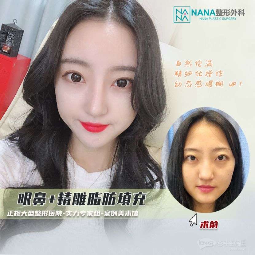 韩国nana整形医院 性价比最高的抗衰童颜项目 Nana脂肪填充 韩国整形 牙科奋斗在韩国韩国留学生华人论坛奋韩网 奋斗在韩国
