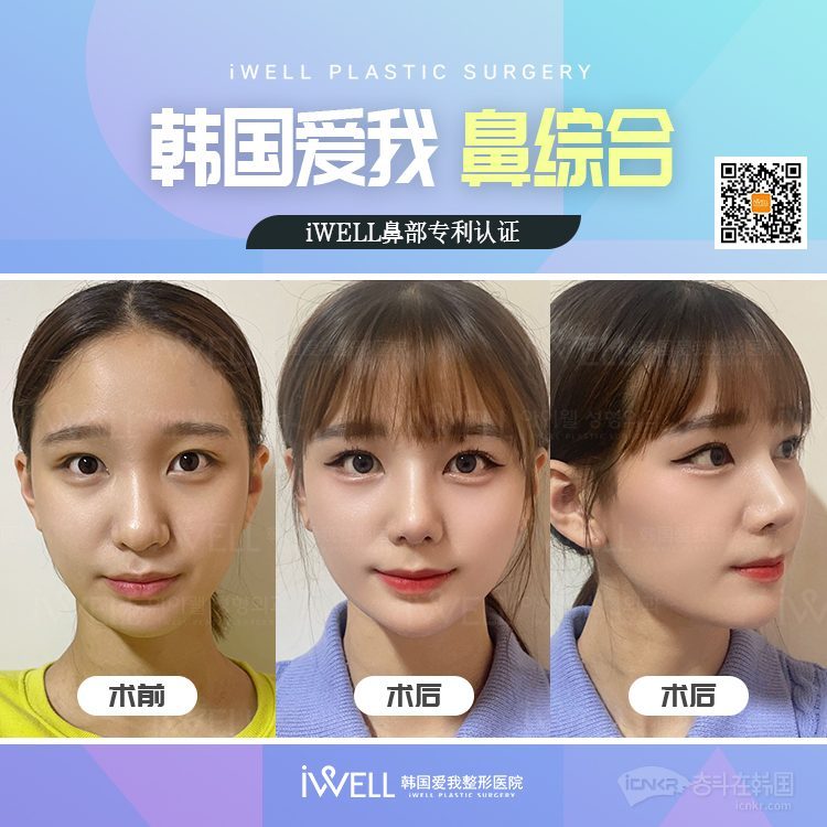 【韩国爱我整形医院】鼻型矫正!鹰钩鼻、福鼻、短鼻、宽鼻、歪鼻等 ️半价模特招募!-韩国整形 牙科 奋斗在韩国 韩国留学生华人论坛 奋韩网