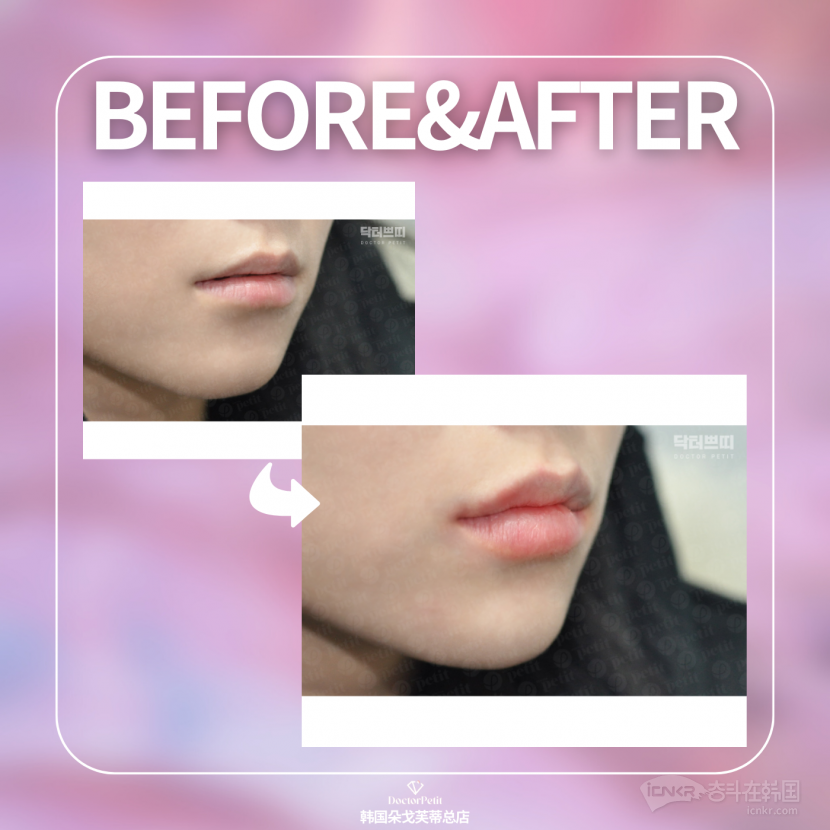 韩国dr·petit朵戈芙蒂皮肤科 想要自然增加嘴唇饱满度 请选择🙌乔雅登玻尿酸！韩国整形 牙科 奋斗在韩国 韩国留学生华人论坛 奋韩网
