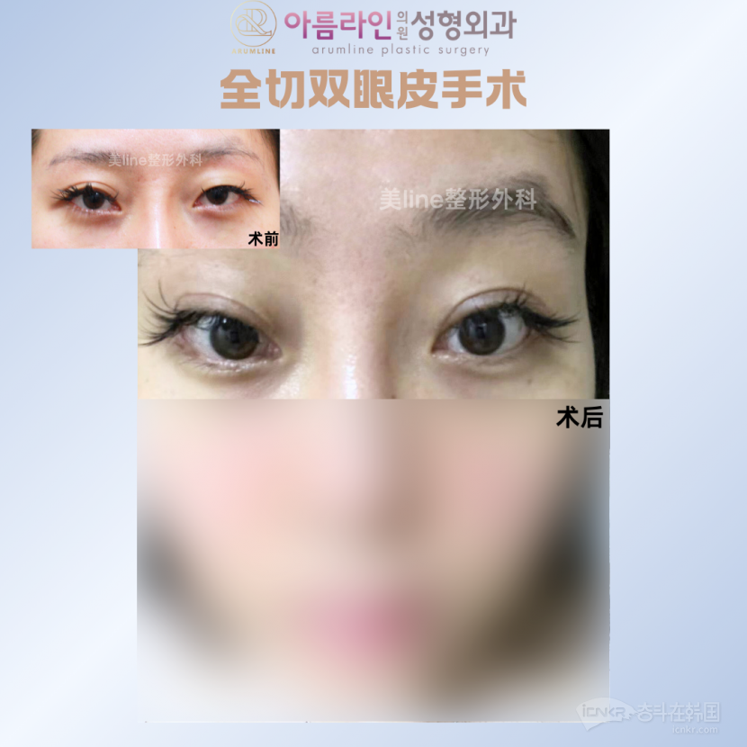 ❤美line整形外科❤实力经验院长1:1 双眼皮埋线/全切/修复/除皱针，瘦脸针