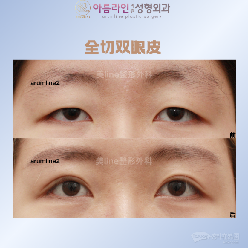 ?美line整形外科?雙眼皮實(shí)力院長(zhǎng)1V1 全切雙眼皮/埋線/自然粘連/雙眼皮修復(fù)